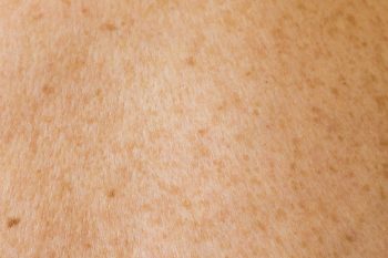Les mélanomes : tout ce qu’il faut savoir sur ces cancers de la peau