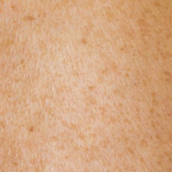 Les mélanomes : tout ce qu’il faut savoir sur ces cancers de la peau