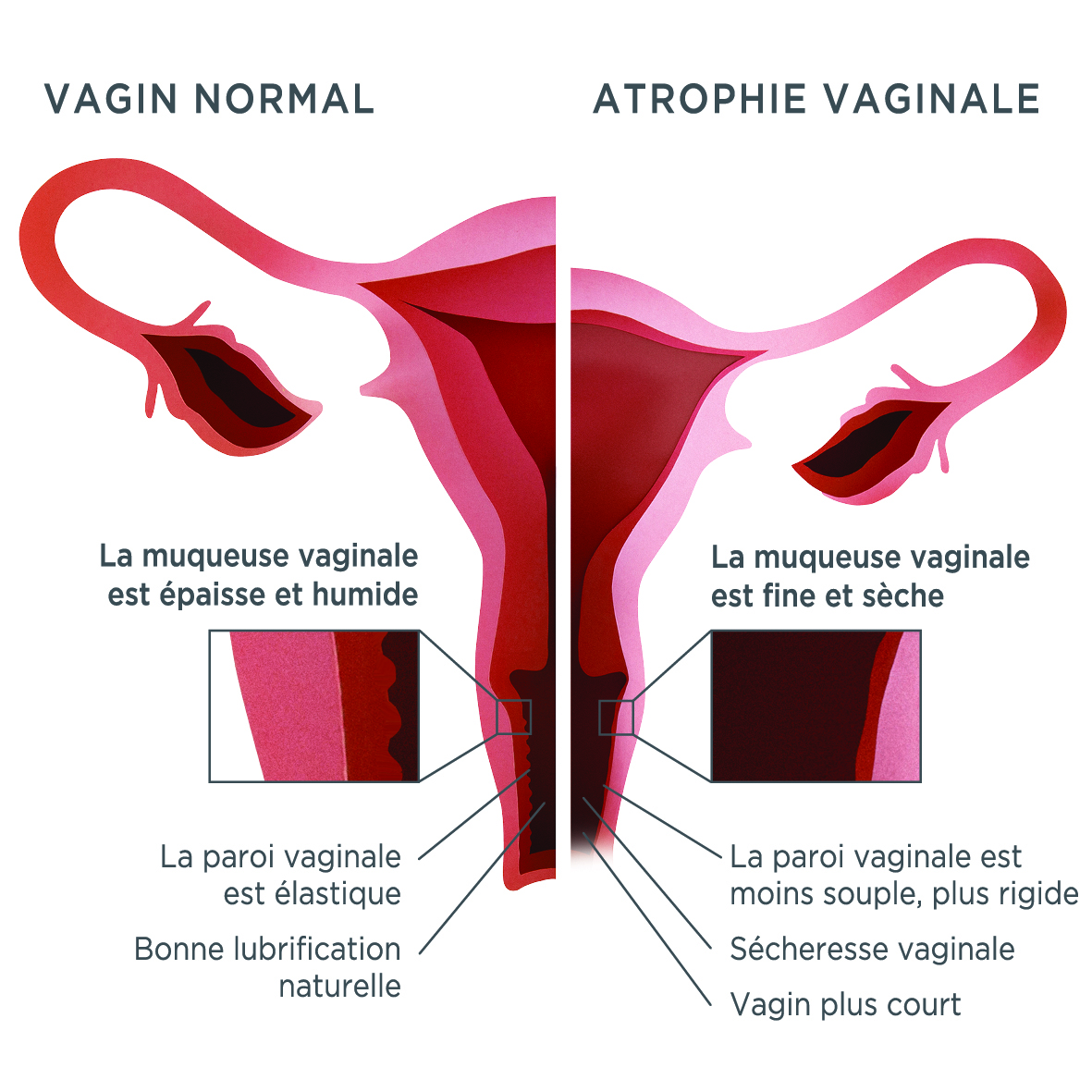 SCHEMA_ATROPHIE-VAGINALE